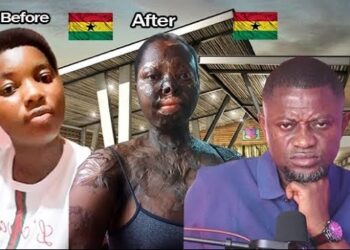 My ex had his friend pour acid on me after stalking and refusing to do a blood covenant with him – Lady reveals
